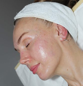 biorevitalizaciya-omolazhivayushchaya-succinate-lift-booster-v-ekaterinburge
